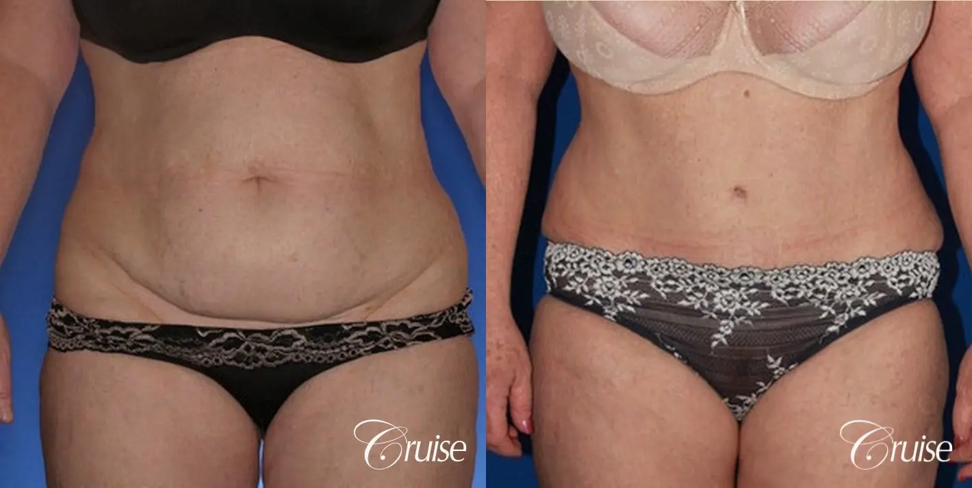 female photos of tummy tuck results - Before and After 1