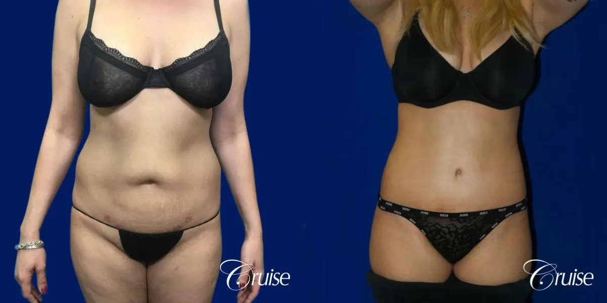Tummy Tuck Standard Incision - Before and After  