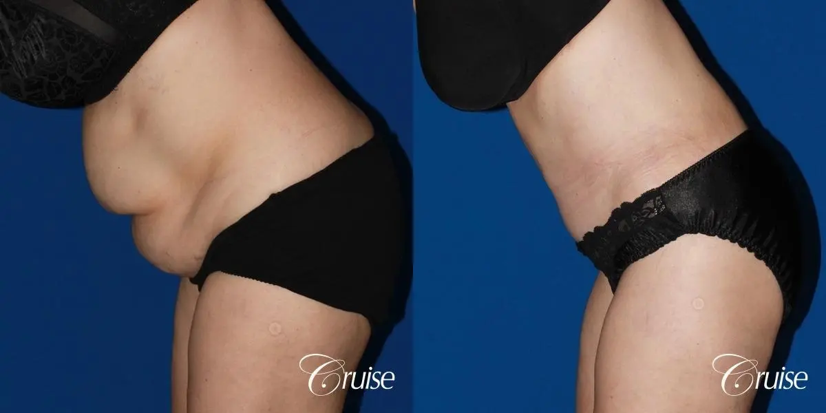 Tummy Tuck: Patient 28 - Before and After 4