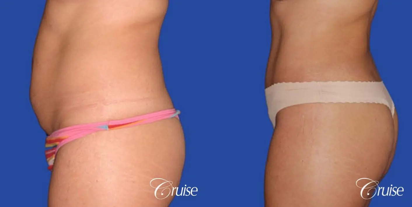 best standard tummy tuck scar on small female patient - Before and After 2