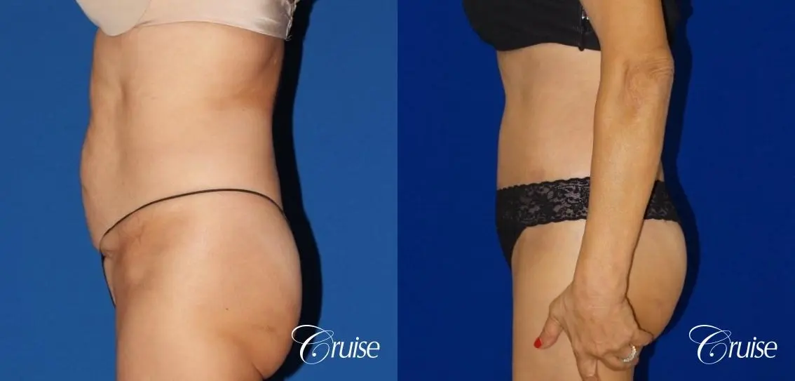 Tummy Tuck Extended Incision - Before and After 2