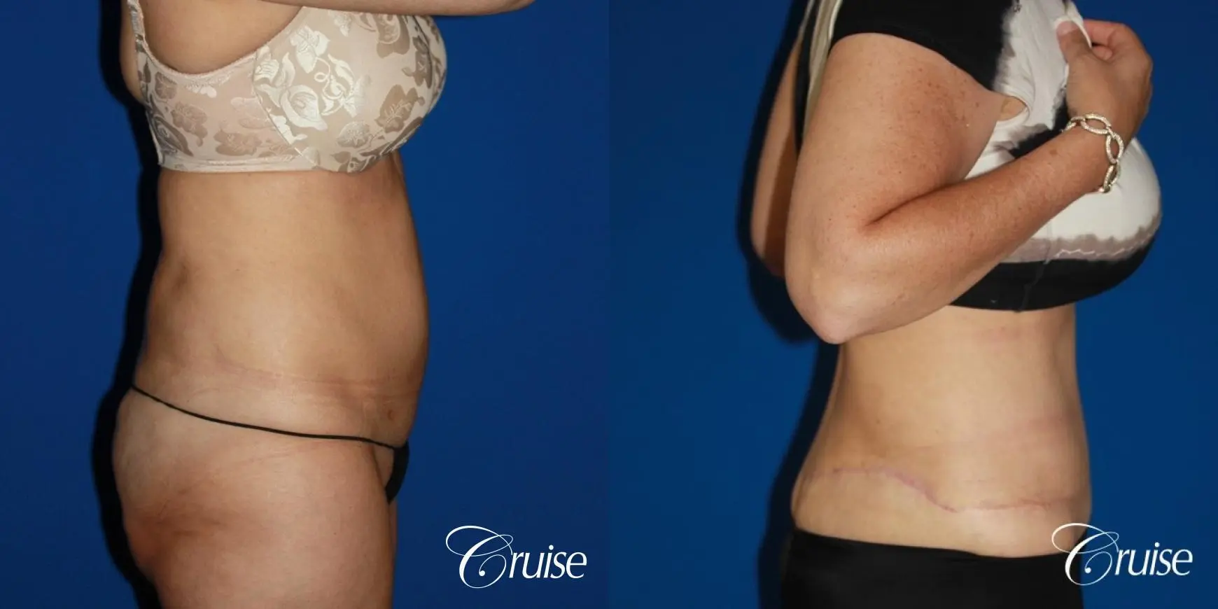 Circumferential Tummy Tuck - Before and After 3