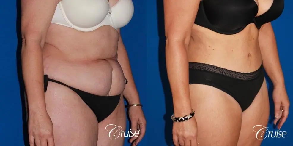 Tummy Tuck: Patient 28 - Before and After 3
