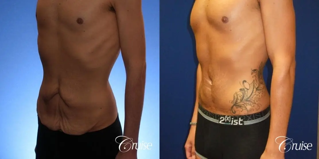 Weight Loss Tummy Tuck: 22 Yr Old Male - Before and After 3