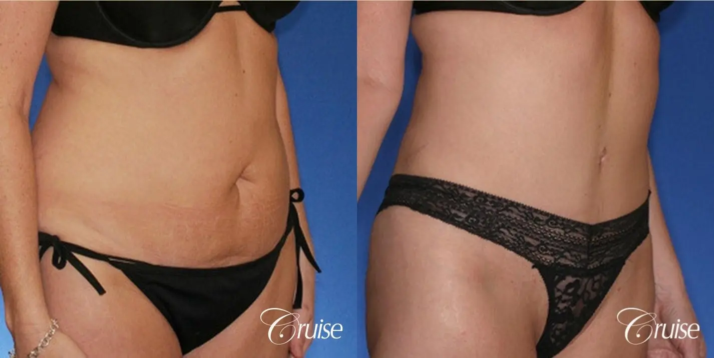 best tummy tuck with liposuction flanks - Before and After 5