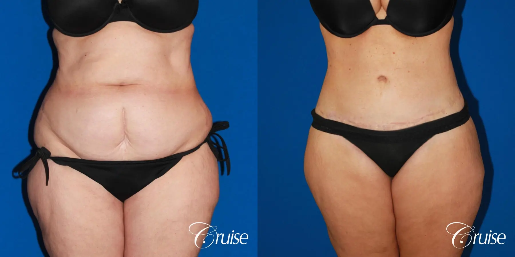 Tummy Tuck: Patient 86 - Before and After 1