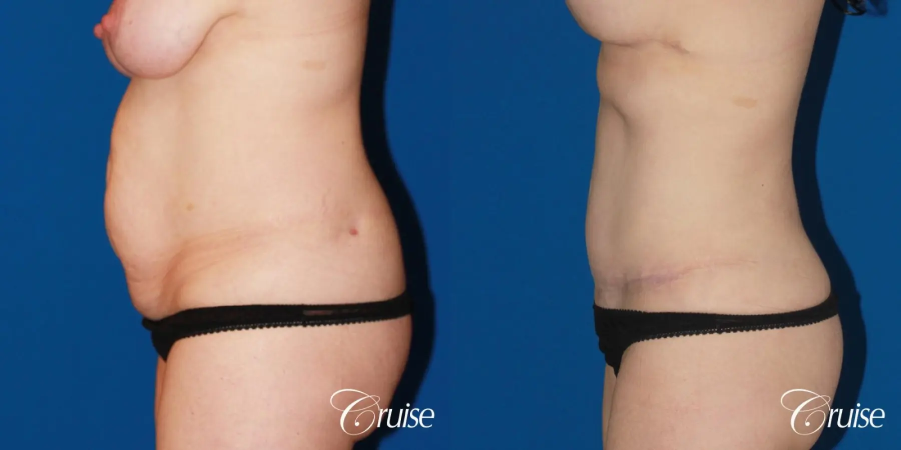 Tummy Tuck: Patient 20 - Before and After 2