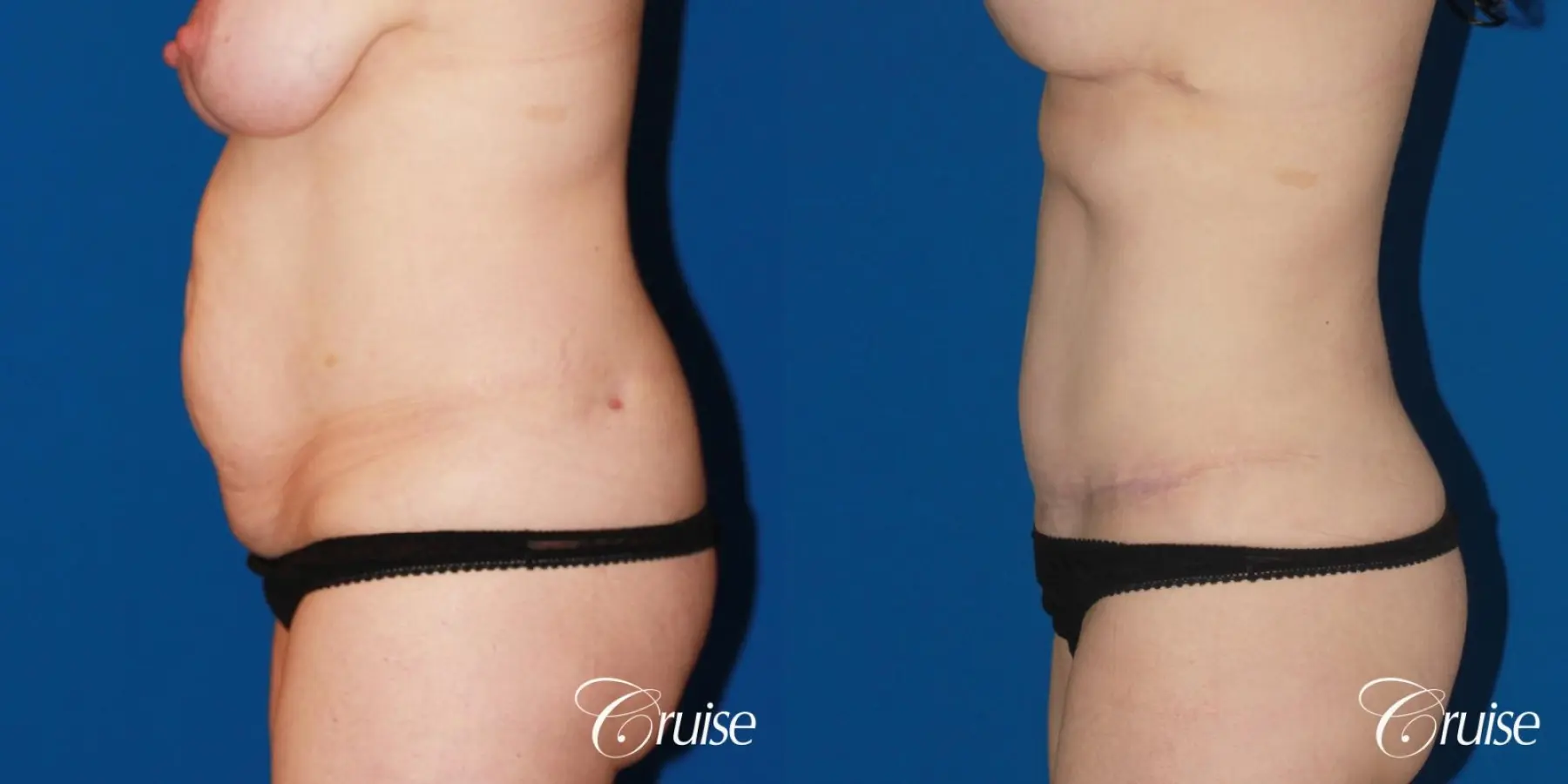 Tummy Tuck: Patient 25 - Before and After 2
