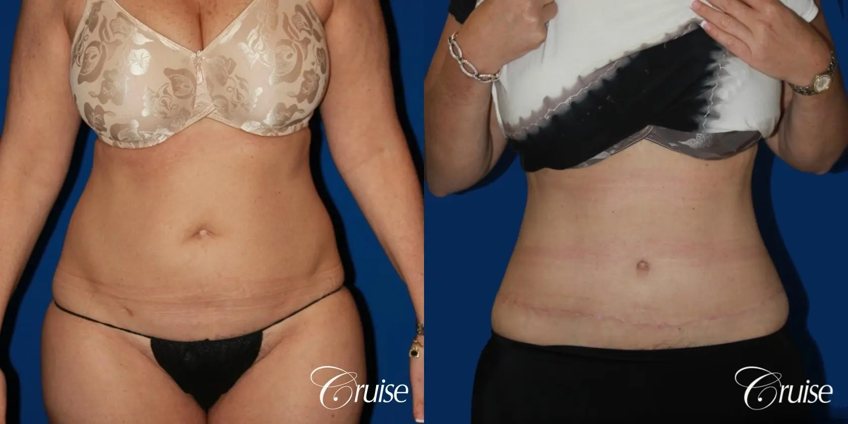 Circumferential Tummy Tuck - Before and After 1