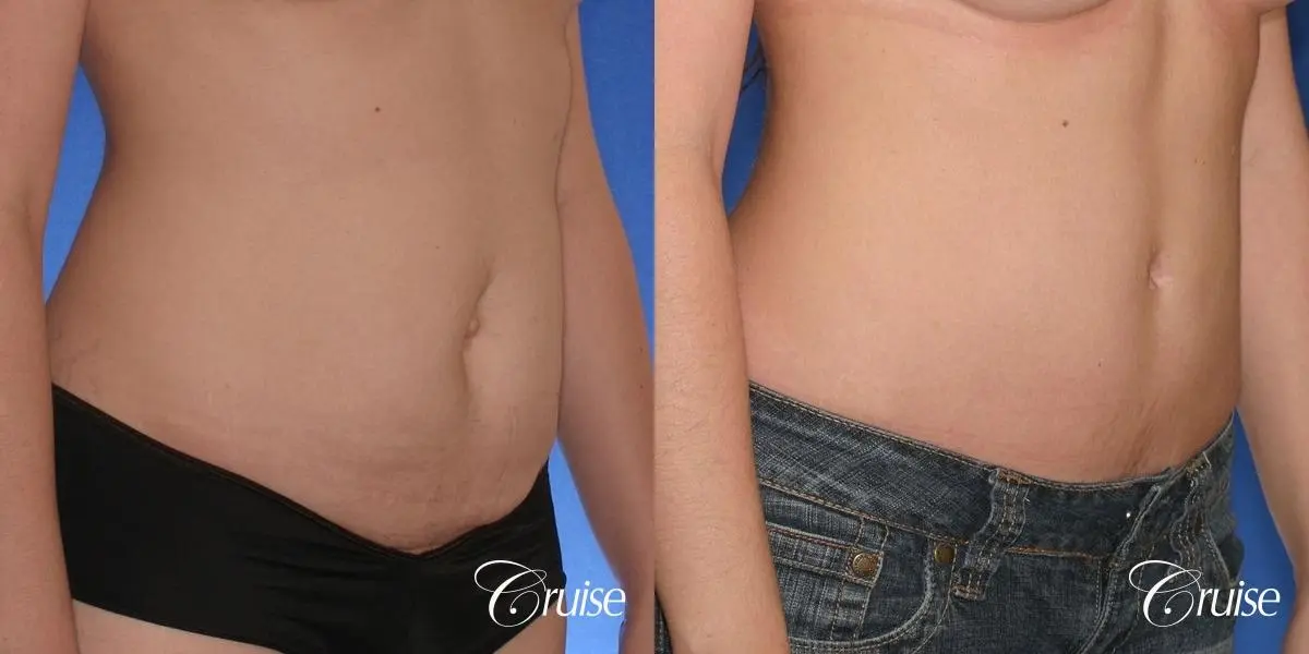 Tummy Tuck: Patient 38 - Before and After 3