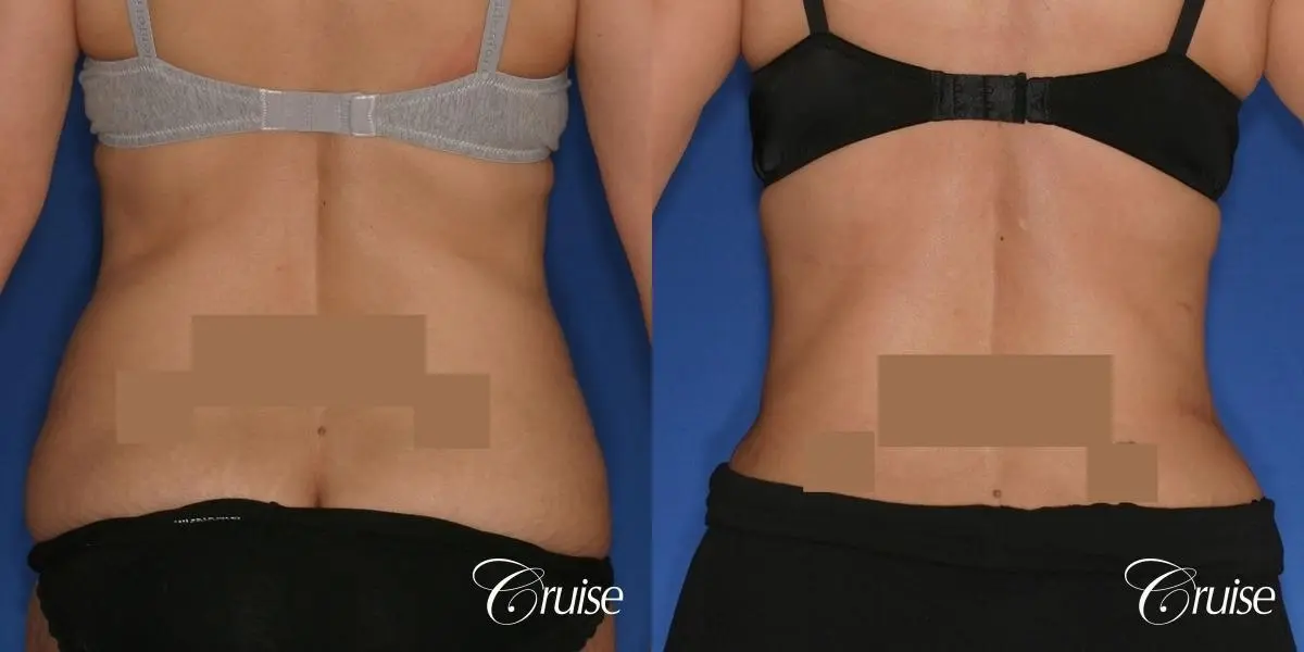 Tummy Tuck - Standard Incision - Before and After 4