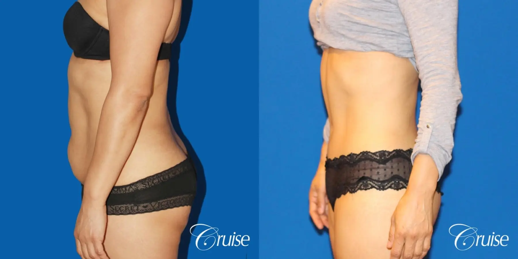 Tummy Tuck: Patient 21 - Before and After 2