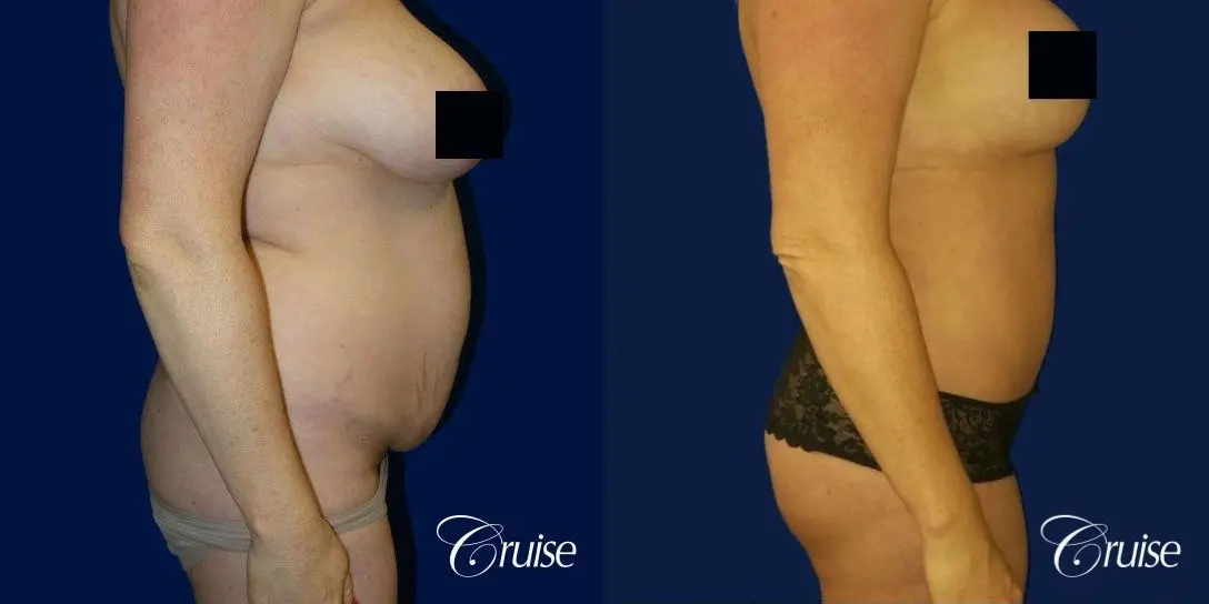 Best tummy tucks dr cruise - Before and After 4
