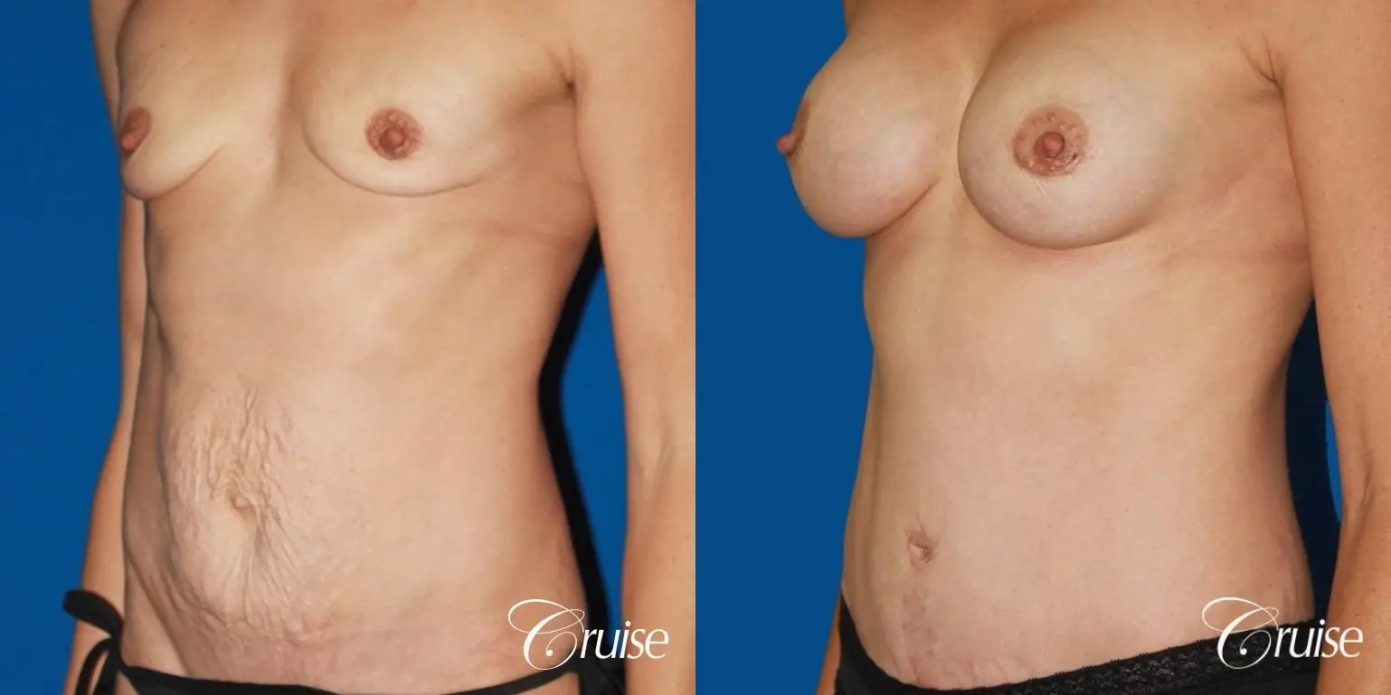 Tummy Tuck: Patient 25 - Before and After 3