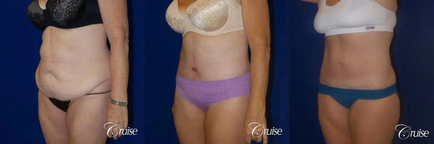 62 Yr Old Female Circumferential Tummy Tuck w/BBL & Liposuction - Before and After 4