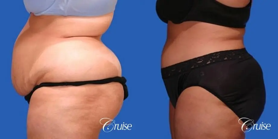 Tummy Tuck - Extended - Before and After 2