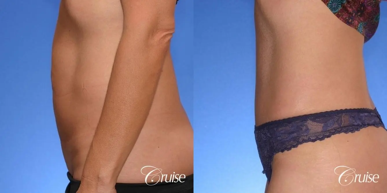 best scar on thin female tummy tuck patient - Before and After 2