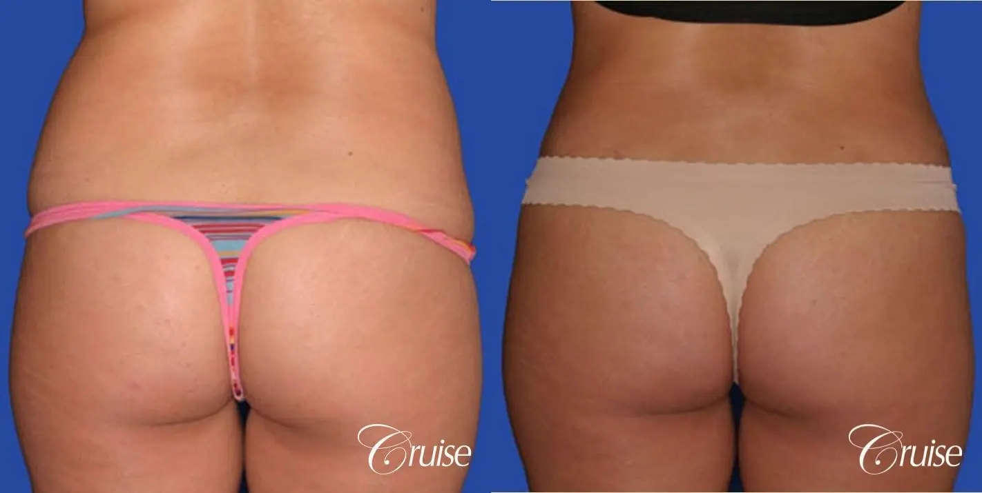 best standard tummy tuck scar on small female patient - Before and After 3