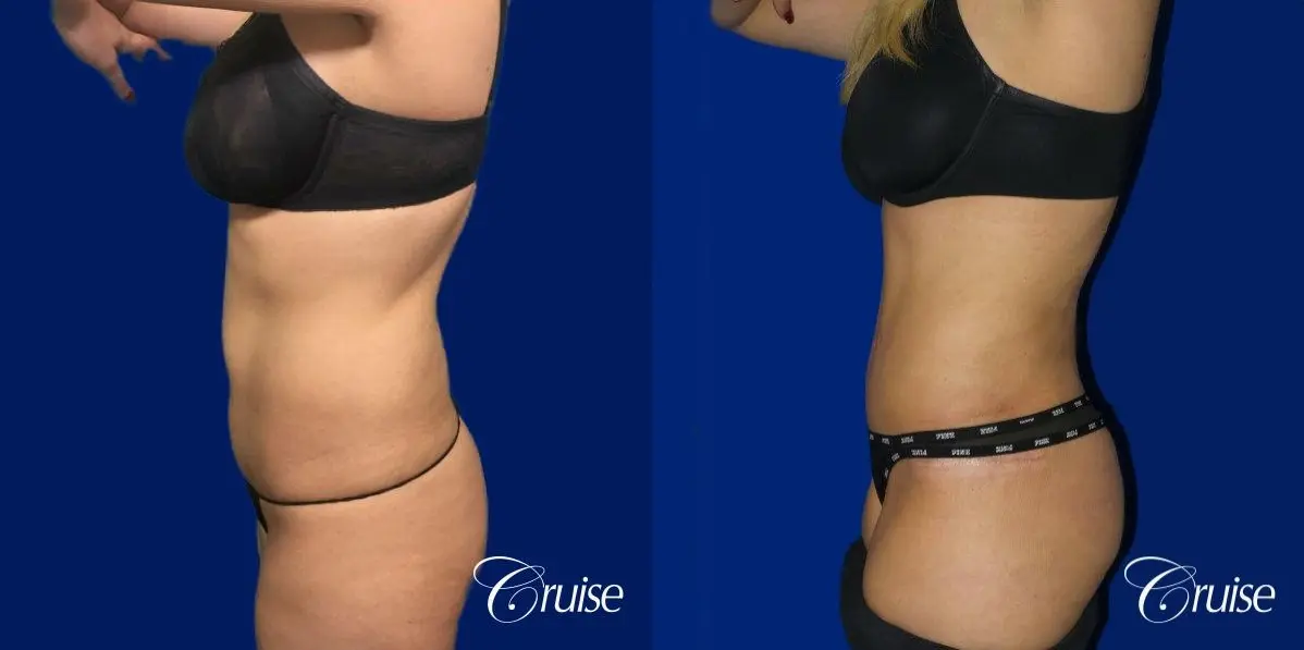 Tummy Tuck Standard Incision - Before and After 2