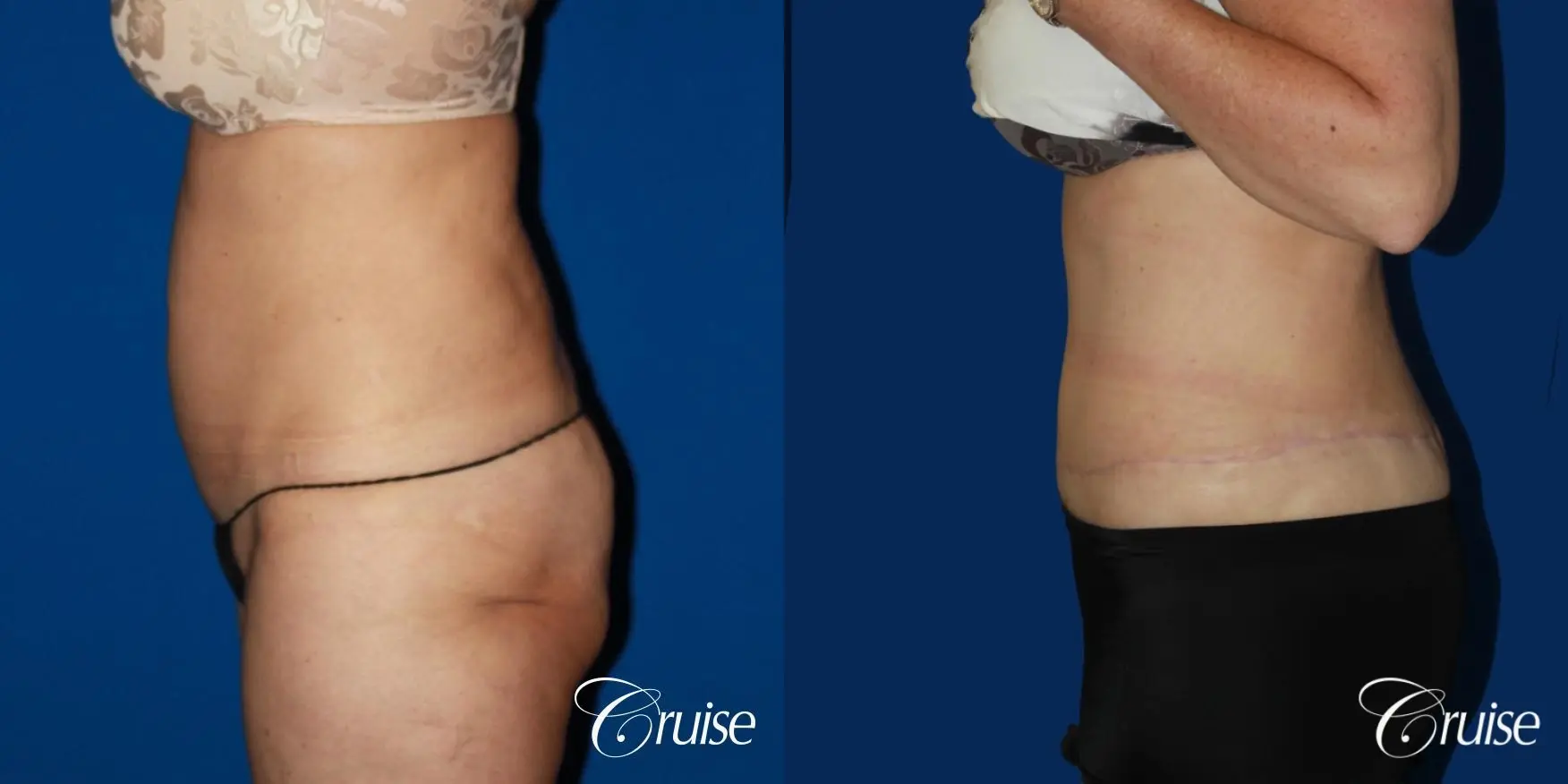 Circumferential Tummy Tuck - Before and After 2