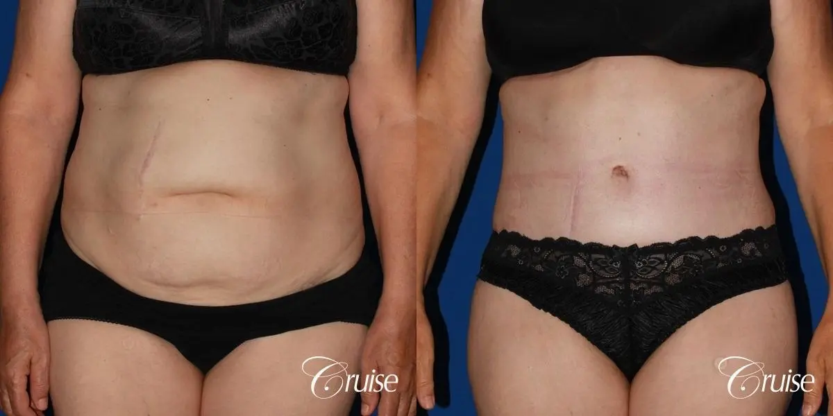 Tummy Tuck: Patient 28 - Before and After 1