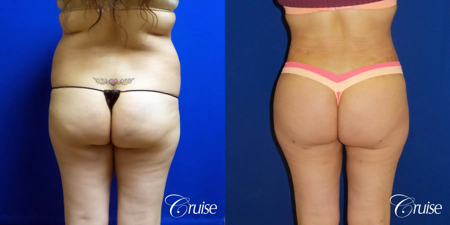 Tummy Tuck Extended Incision - Before and After 4