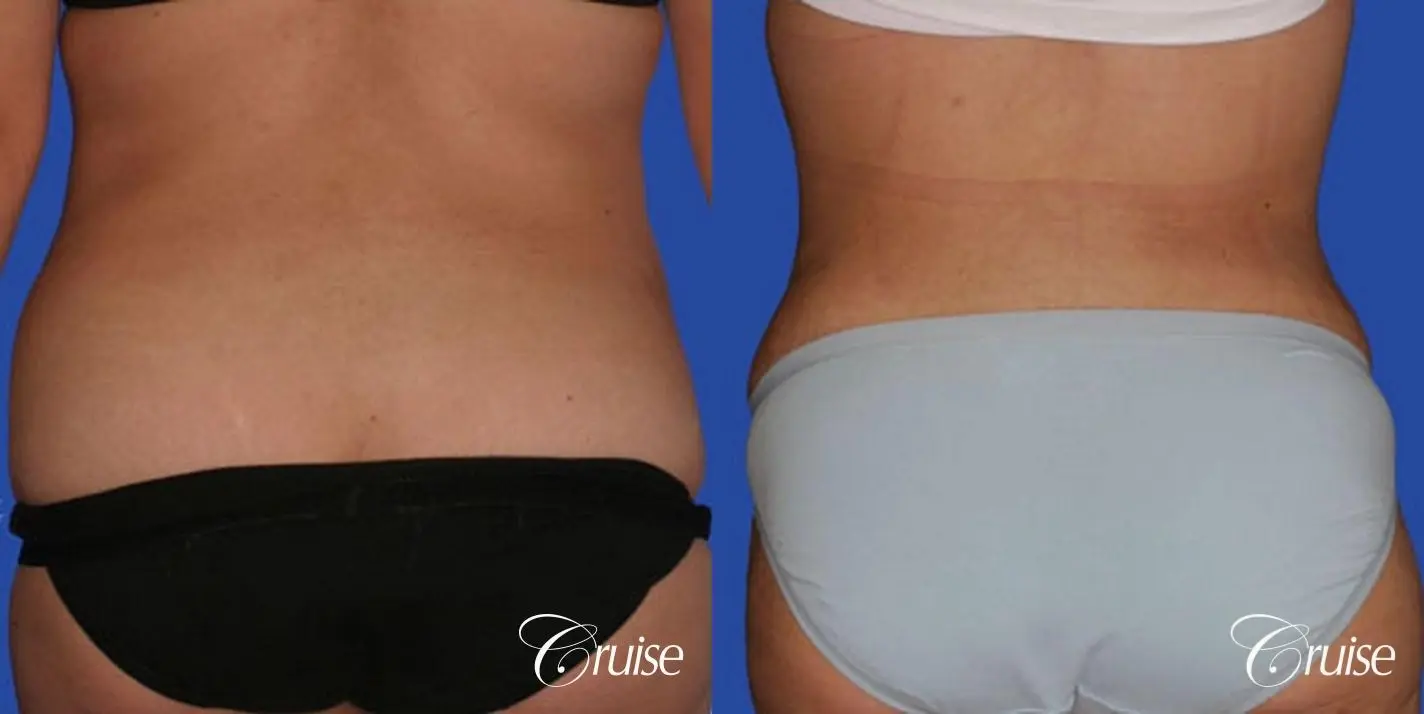before and after tummy tuck pictures plastic surgeon - Before and After 3