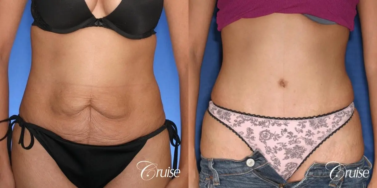 Tummy Tuck: Patient 59 - Before and After 1