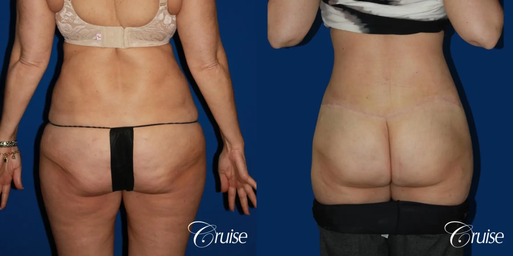 Circumferential Tummy Tuck - Before and After 4