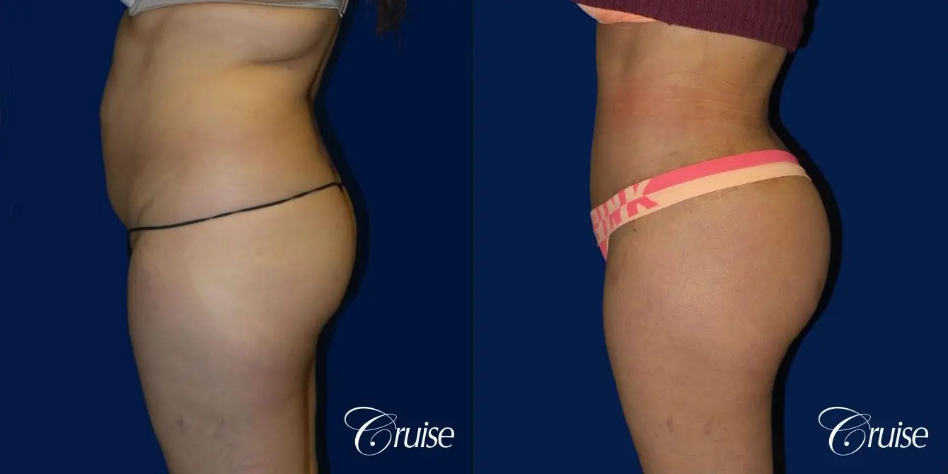 Tummy Tuck Extended Incision - Before and After 3