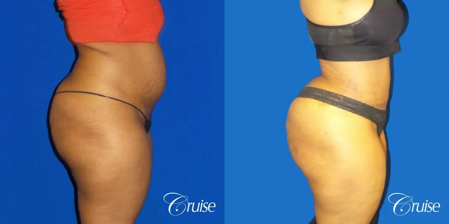 Best Tummy Tuck surgeons Newport Beach - Before and After 4