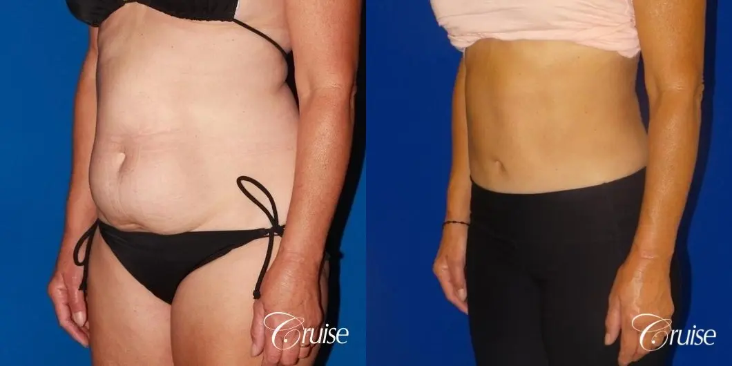 low scar on tummy tuck - Before and After 2