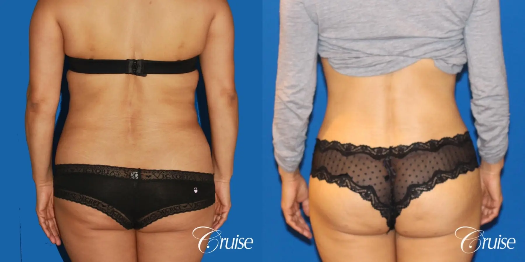 Tummy Tuck: Patient 15 - Before and After 5