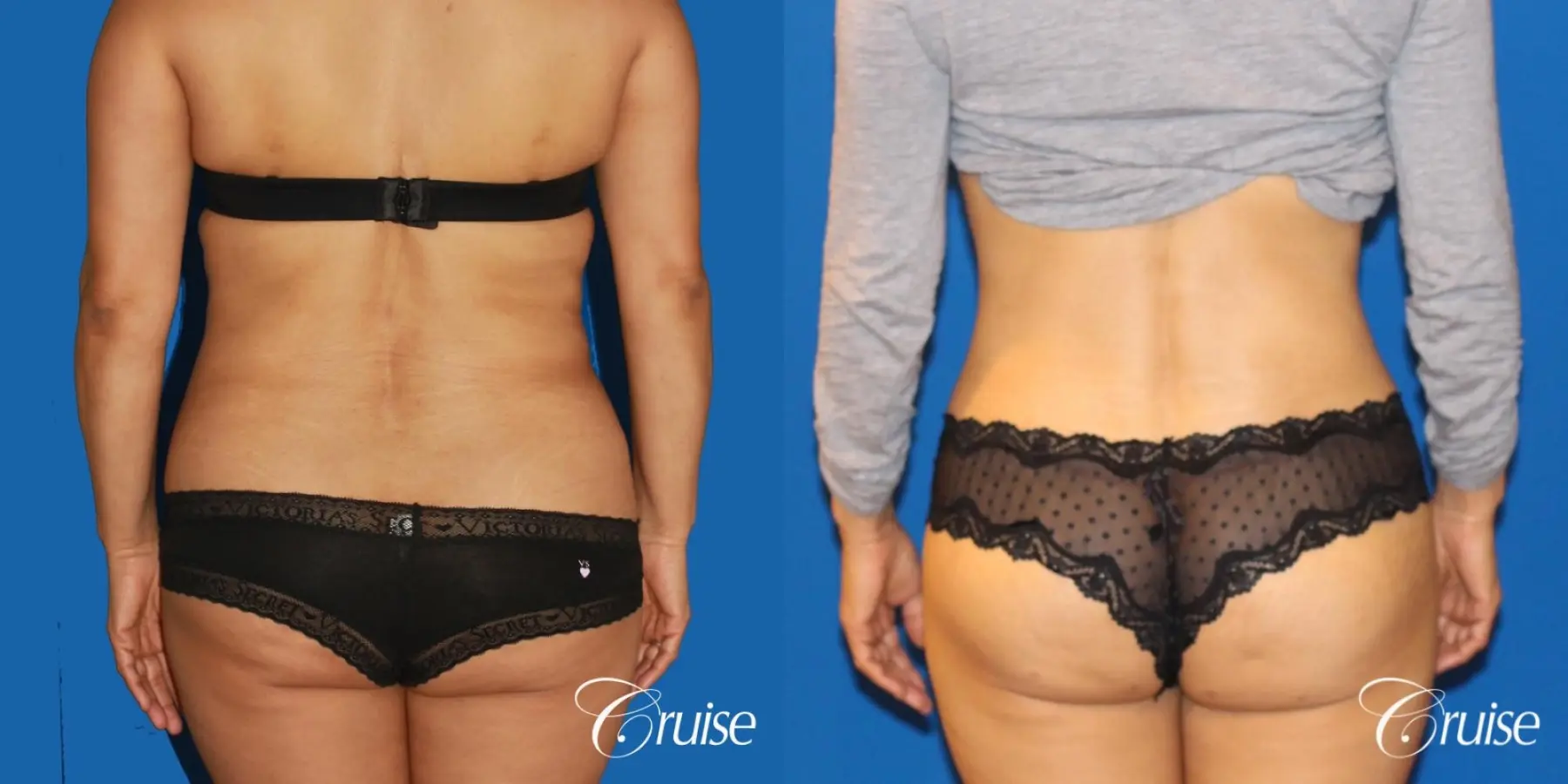 Tummy Tuck: Patient 21 - Before and After 5