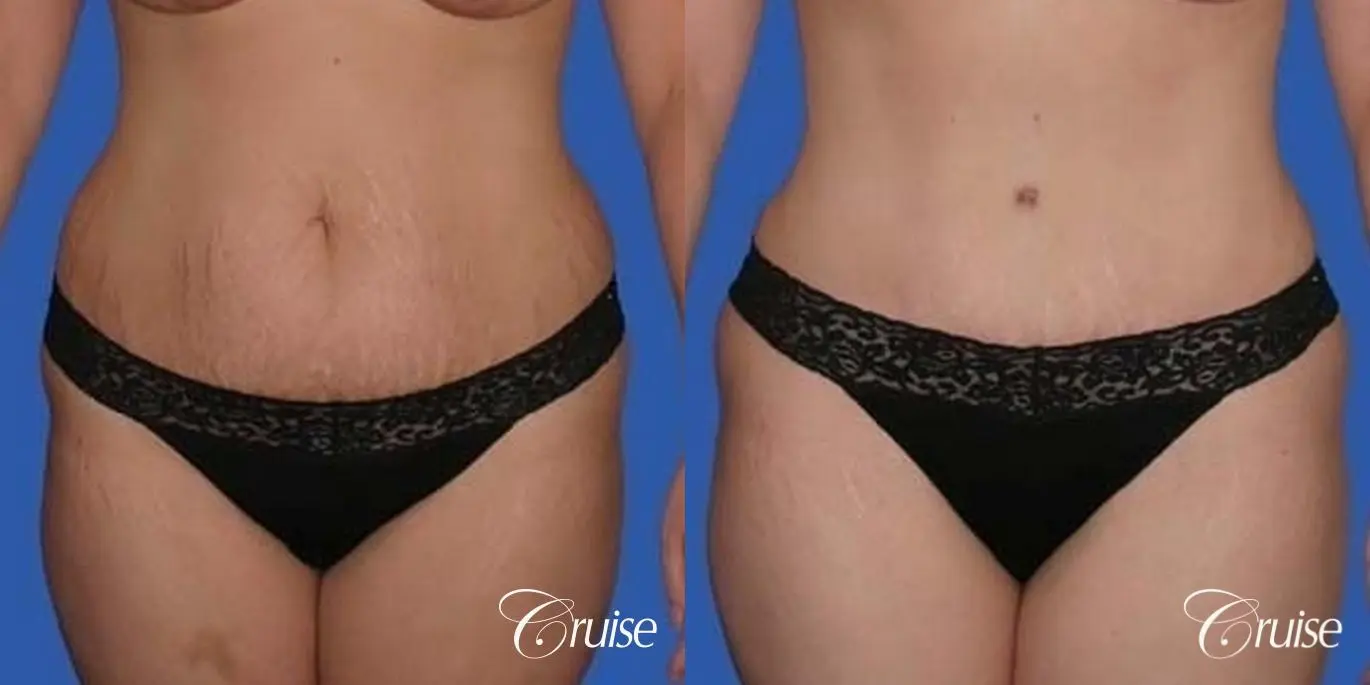 best photos of mom with tummy tuck - Before and After 1