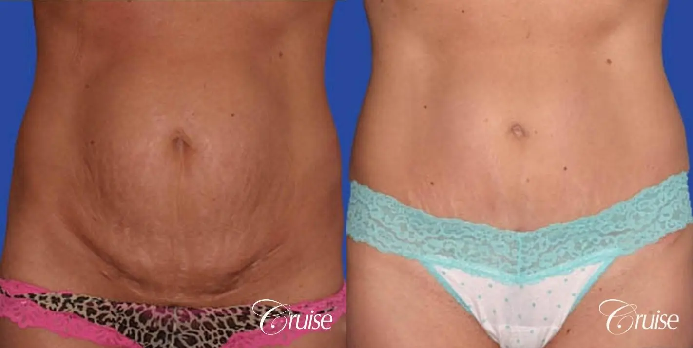 best photos of standard abdominoplasty tummy tuck scar - Before and After 1