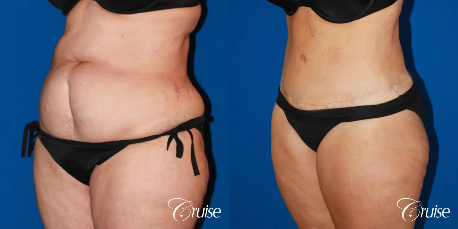 Tummy Tuck: Patient 80 - Before and After 4