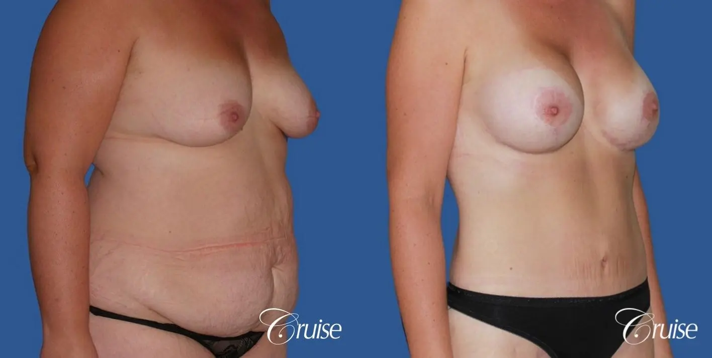 best before and after tummy tuck - Before and After 4