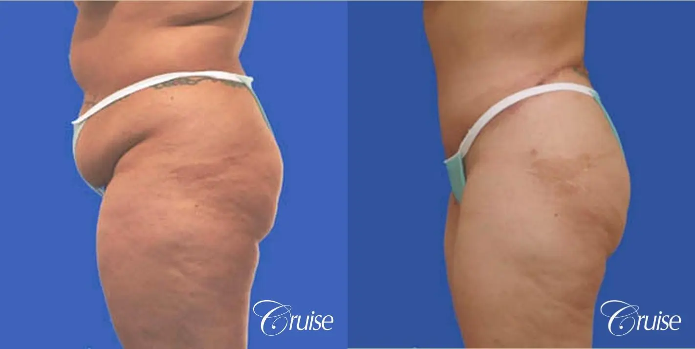 best extended incision tummy tuck scar - Before and After 2