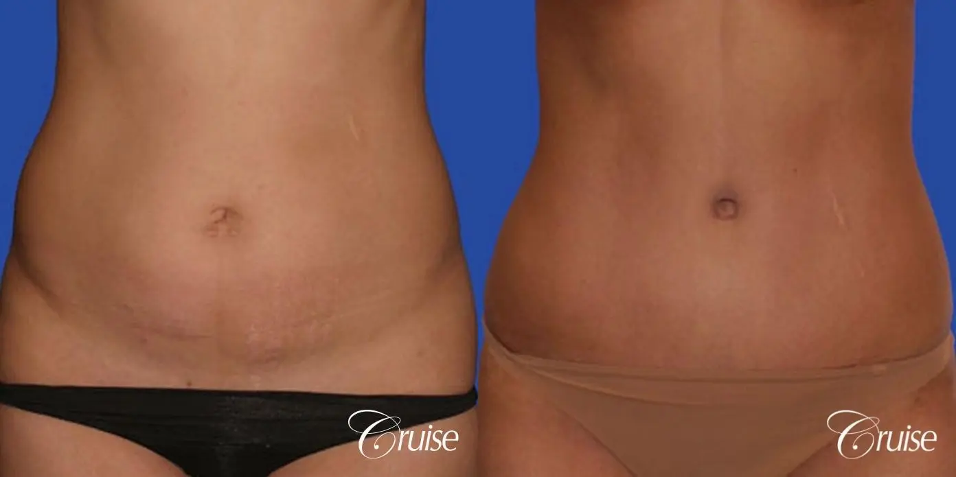 best standard abdominoplasty tummy tuck with top surgeon - Before and After 1