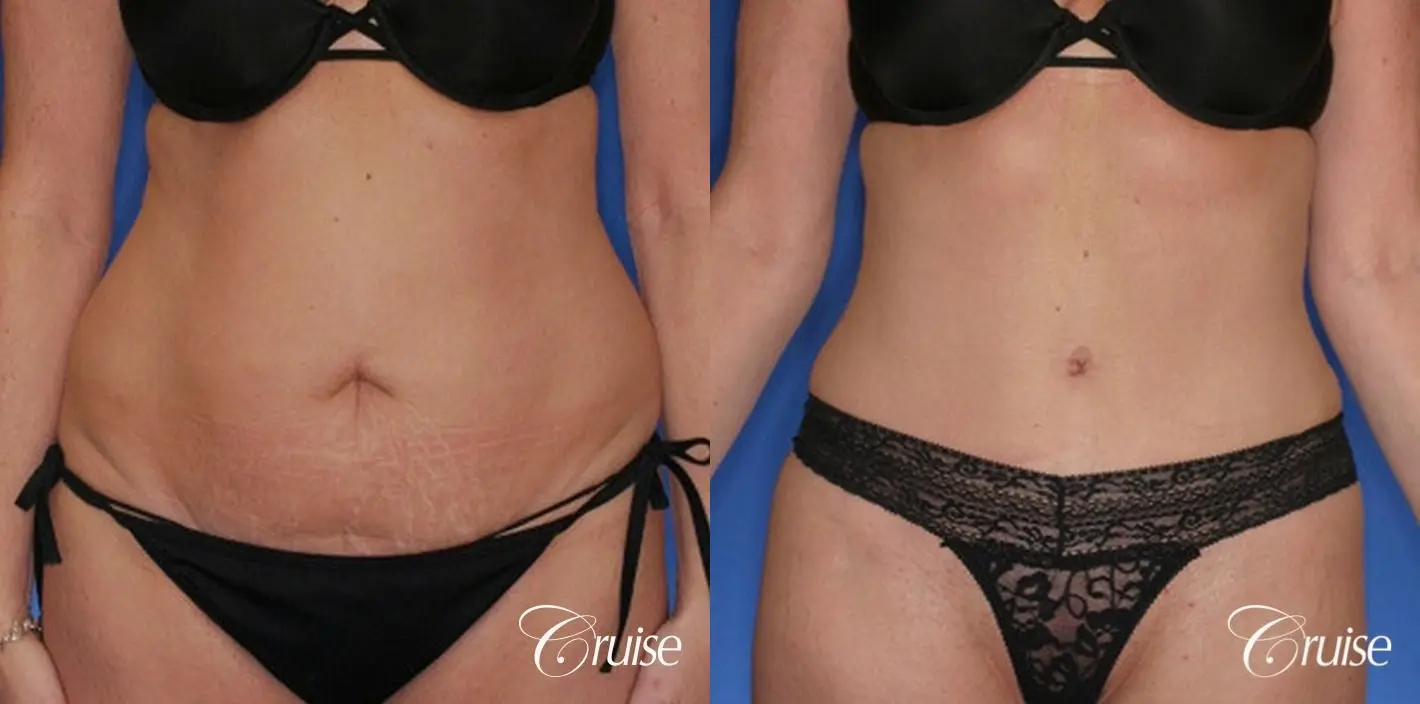 best tummy tuck with liposuction flanks - Before and After 1