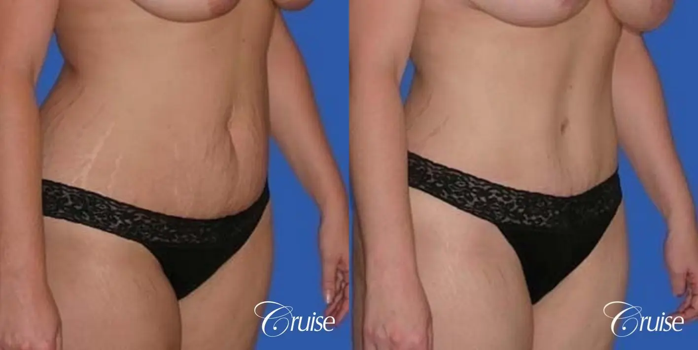 best photos of mom with tummy tuck - Before and After 4