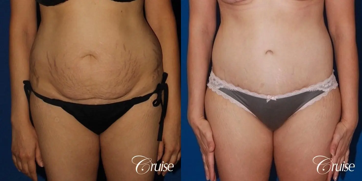 best female body lift with circumferential scar - Before and After 1