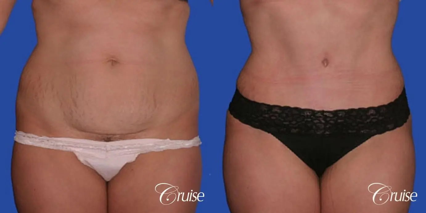 best tummy tuck on 33 year old in Newport Beach - Before and After 1