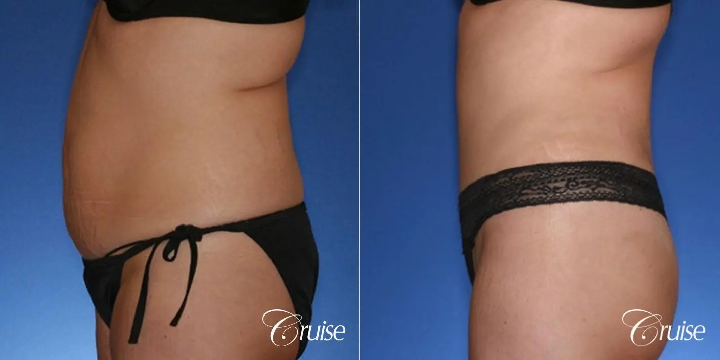 best tummy tuck with liposuction flanks - Before and After 3