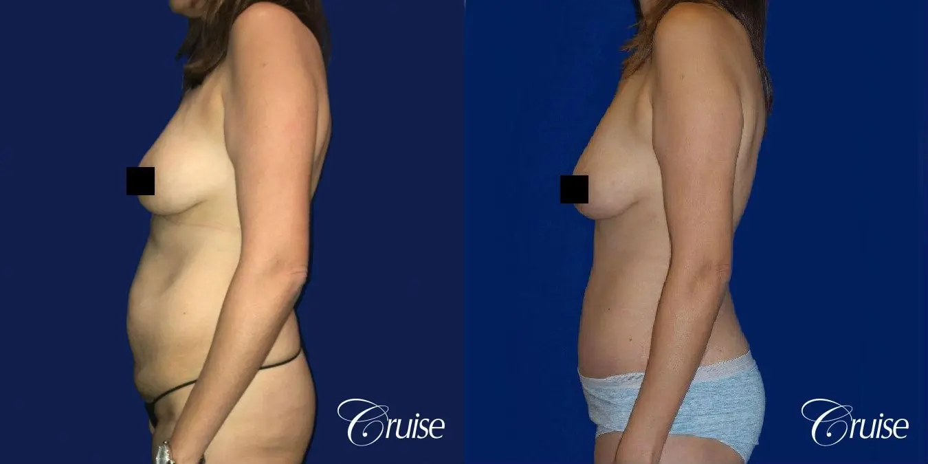 Best tummy tuck incisions orange county - Before and After 3