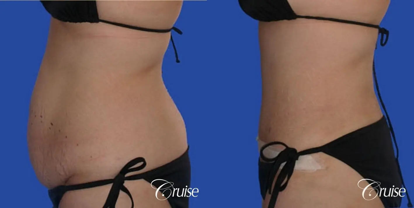 large tummy tuck on young girl - Before and After 4