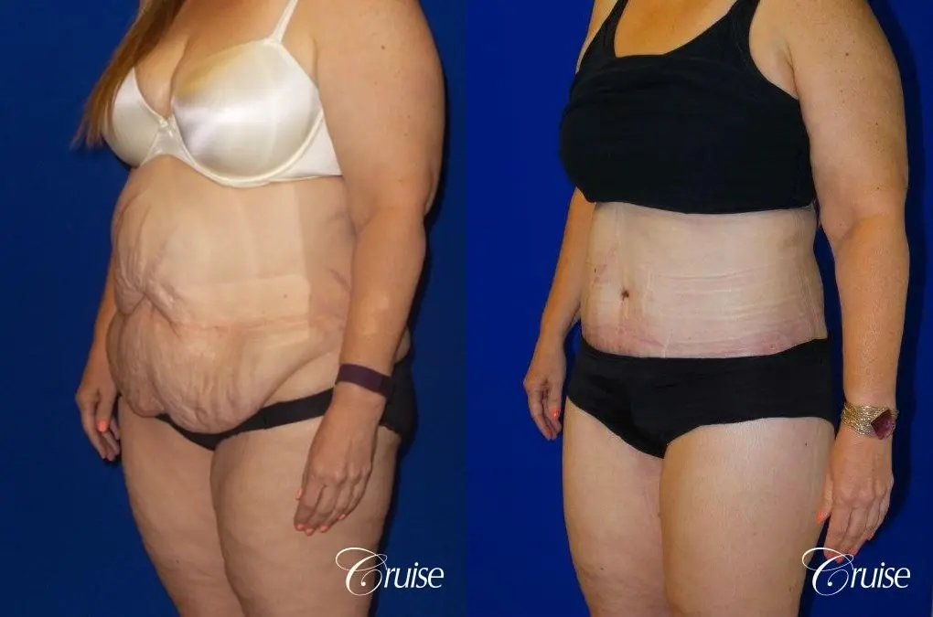 Tummy Tuck Circumferential Incision - Before and After 3