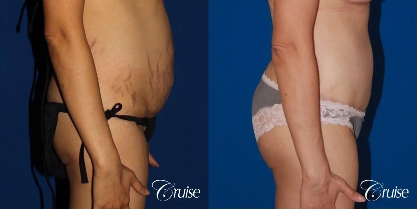 best female body lift with circumferential scar - Before and After 3