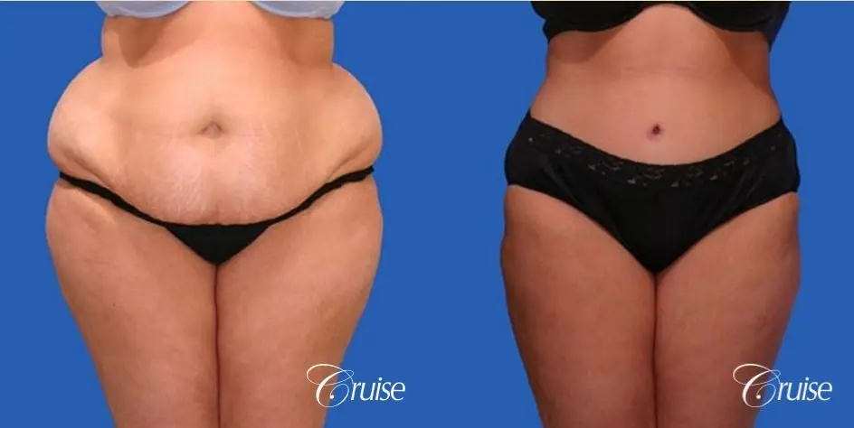 Tummy Tuck - Extended - Before and After 1